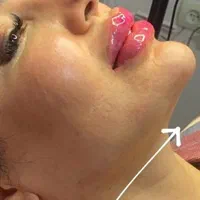تزریق وآموزش ژل و بوتاکس چربی توسط دانشجویی پزشکی|خدمات آرایشگری و زیبایی|اهواز, زیتون کارمندی|دیوار