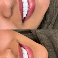 کامپوزیت باشرایط ویژه و باپیش پرداخت