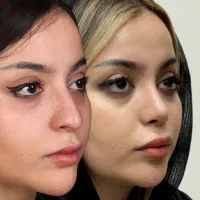 عمل جراحی بینی با روش نوین و با ۵۰درصد تخفیف
