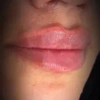 تزریق ژل ،بوتاکس،مزو توسط پزشک