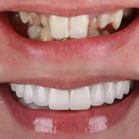 بلیچینگ، درمان و زیبایی بیمه تکمیلی(وآزاداقساطی)|خدمات آرایشگری و زیبایی|بافت, |دیوار