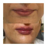 تزریق فیلر لب و بوتاکس در کلینیک زیبایی