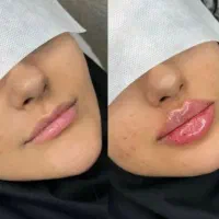 لیزرموهای زائد