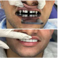 کامپوزیت زیبایی دندان