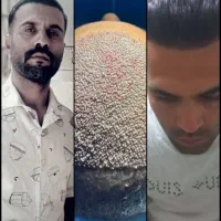 کاشت ابرو بدون نیاز به جراحی کاشت مو شیرازیvip