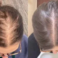 قطع ریزش ورشد مجدد مو باسلول بنیادی توسط پزشک نخبه|خدمات آرایشگری و زیبایی|اصفهان, آبشار|دیوار