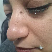 برداشتن انواع خال گوشتی و زگیل ومیکرونیدلینگ|خدمات آرایشگری و زیبایی|قم, انصار‌الحسین|دیوار