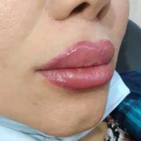 تزریق ژل لب