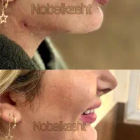 بلفاروپلاستی|خدمات آرایشگری و زیبایی|ارومیه, |دیوار