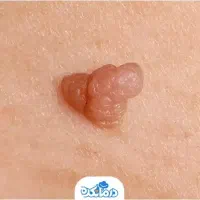 ریمو تخصصی زگیل و...