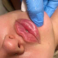 تزریق ژل و بوتاکس بدون درد و کبودی|خدمات آرایشگری و زیبایی|بروجن, |دیوار