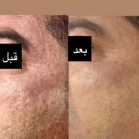 رفع گودی‌ صورت با تکنیک انحصاری و نتایج واقعی|خدمات آرایشگری و زیبایی|شیراز, ارم|دیوار