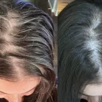 بازسازی پیشرفته فولیکول