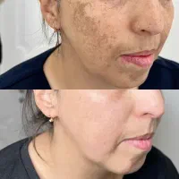 مدل رایگان برای رفع لک پوست با کرم ضدلک + مزو صورت|خدمات آرایشگری و زیبایی|شیراز, جوادیه|دیوار