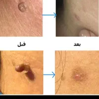 لیزرخال وزگیل منگوله های گوشتی بدون درد|پزشکی|دورود, |دیوار