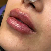 تزریق فیلر لب با متدهای ترند اینستا - دکتر واحدی|خدمات آرایشگری و زیبایی|قزوین, |دیوار