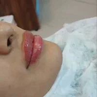 جشنواره زیبایی لیزر فیلر بوتاکس زگیل خال|خدمات آرایشگری و زیبایی|تهران, یافت آباد شمالی|دیوار