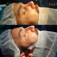 عمل بینی اقساطی فقط با ماهی ۳ تومن استخوانی وگوشتی