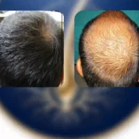 چرا ریشت کامل درنمیاد بیا