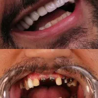 دندانپزشکی،ایمپلنت،اوردنچر با اقساط دو ساله|خدمات آرایشگری و زیبایی|اهر, |دیوار