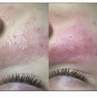 فیشیال (پاکسازی) خالبرداری و پلاسما صورت|خدمات آرایشگری و زیبایی|کوهدشت, |دیوار