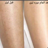 لیزر موژان|خدمات آرایشگری و زیبایی|تهران, اتابک|دیوار