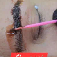 ریموو تتوی قدیمی فقط در یک جلسه