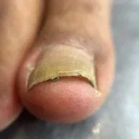 فرورفتگی ناخن توگوشت|آرایشی، بهداشتی، درمانی|انار, |دیوار