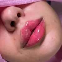 قیمت های وحشتناک به مدت محدود فیلر بوتاکس مزو