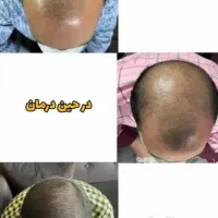 محلول گیاهی ضد ریزش مو و رویش مجدد|آرایشی، بهداشتی، درمانی|شیراز, بهارستان|دیوار