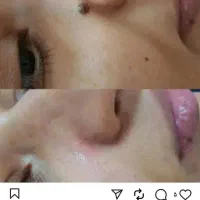 درمان کیست ملیا زیر چشم و برداشتن خال و زگیل|خدمات آرایشگری و زیبایی|نیشابور, دارایی|دیوار