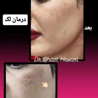 لیزر تزریق بوتاکس ژل فیلر مزوتراپی هایفو توسط پزشک|خدمات آرایشگری و زیبایی|پرند, فاز ۲|دیوار