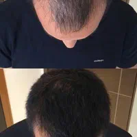 پذیرش مدل اسکالپ سر به صورت رایگان