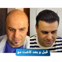 کاشت مو با استثنایی ترین قیمت