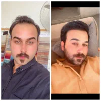 کاشت مو با بالاترین تراکم