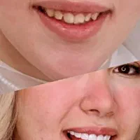 تخفیف ویژه اصلاح طرح لبخند با کامپوزیت و لمینت|خدمات زیبایی و سلامت|اهواز, کیانپارس |دیوار