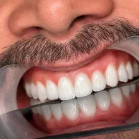 ایمپلنت دندان شروع دوباره لبخند