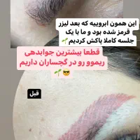 ریموو،پاک کردن تتوی صورت|خدمات آرایشگری و زیبایی|دوگنبدان, |دیوار