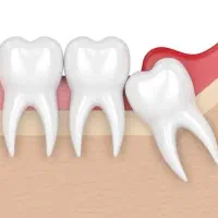 دندان عقل را بدون استرس بکش|خدمات زیبایی و سلامت|تهران, نیاوران|دیوار