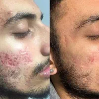 خدمات پوستی برای لک و جای جوش