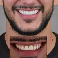 کامپوزیت.لمینت.پروتز.دست دندان|خدمات آرایشگری و زیبایی|تهران, مجیدیه|دیوار