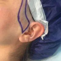 بلفارو/ لیفت صورت و ابرو/غبغب/تزریق چربی با تخفیف|خدمات آرایشگری و زیبایی|مشهد, سجاد شهر|دیوار