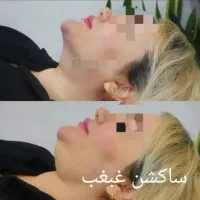 آف تزریق ژل وبوتاکس ومزومووصورت|خدمات آرایشگری و زیبایی|اهواز, نادری|دیوار