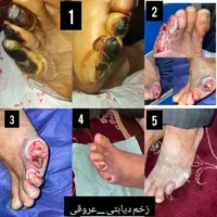 درمان تخصصی زخم‌ دیابتی‌ و زخم‌ بستر|خدمات آرایشگری و زیبایی|شیراز, شهرک پرواز|دیوار