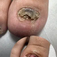 درمان ناخن تو گوشت رفته و قارچ گرفته|آرایشی، بهداشتی، درمانی|ارومیه, |دیوار