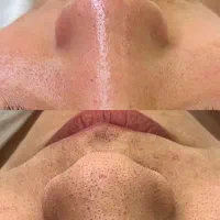 آموزش فیشیال وپاکسازی