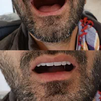 دندانسازی پیرهادی بامتد جدید کنترل لقی دندان|خدمات آرایشگری و زیبایی|ورامین, ورامین|دیوار