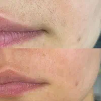 لیزر موهای زائد بدون درد -قیمت استثنایی 300تومان|خدمات آرایشگری و زیبایی|تهران, زعفرانیه|دیوار