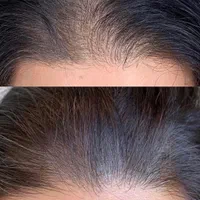 ژل فیلر بوتاکس جوانسازتوسط پزشک زیبایی در کلینیک|خدمات آرایشگری و زیبایی|مشهد, کوثر|دیوار