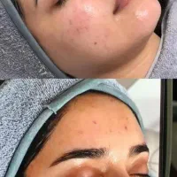 درمان جوش صورت و بدن